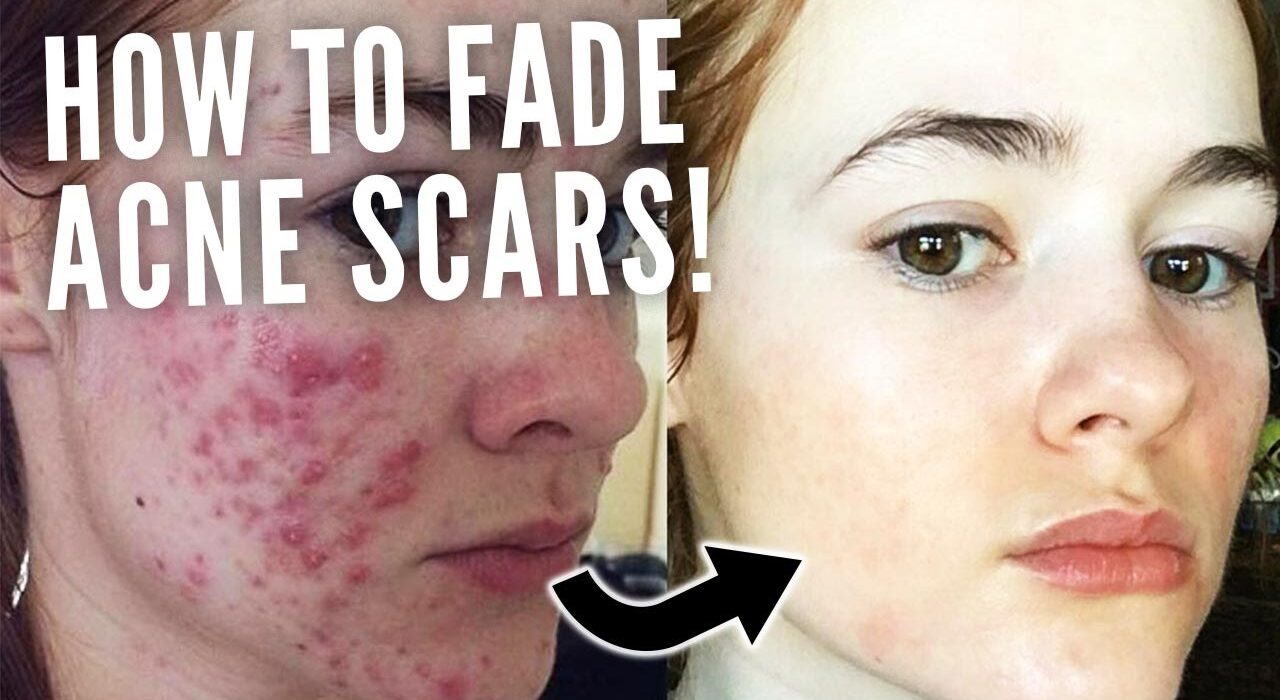 ¿Cuánto tardan en desaparecer las cicatrices del acné?